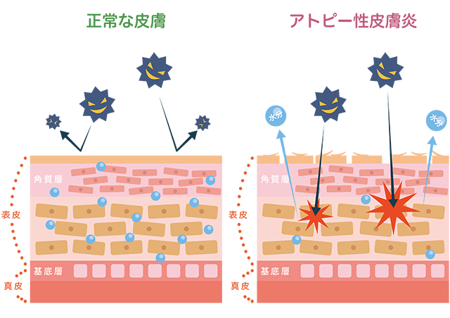 低湿度がアトピー症状を悪化させる
